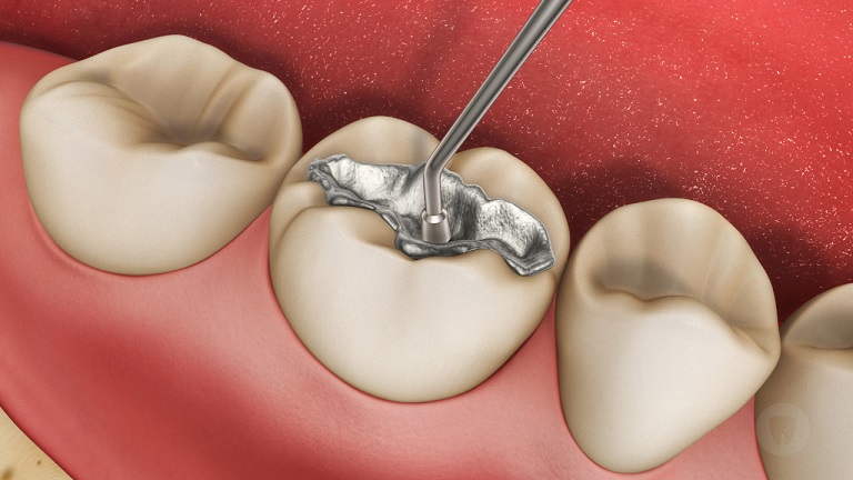 What Remedy Can You Expect After Getting Pain Due to Dental Fillings